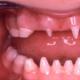 Kaj je hiperdontija zobna bolezen Odvečni zobje rastejo